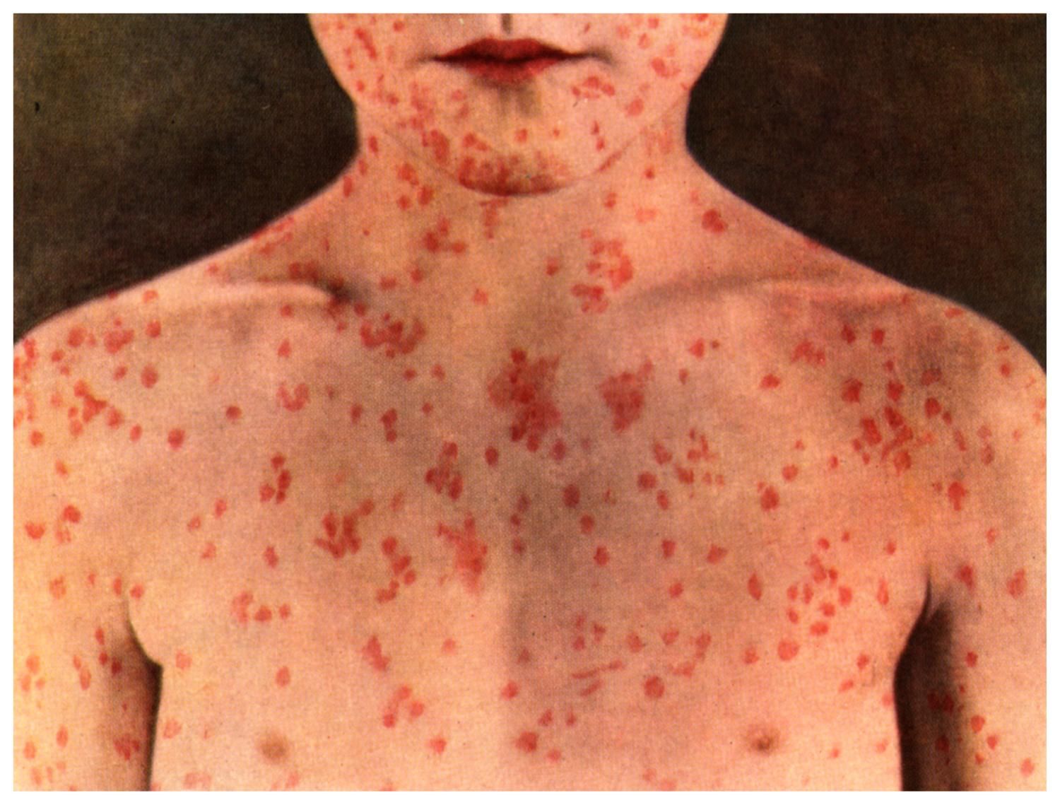 How is measles in an adult How is measles in an adult